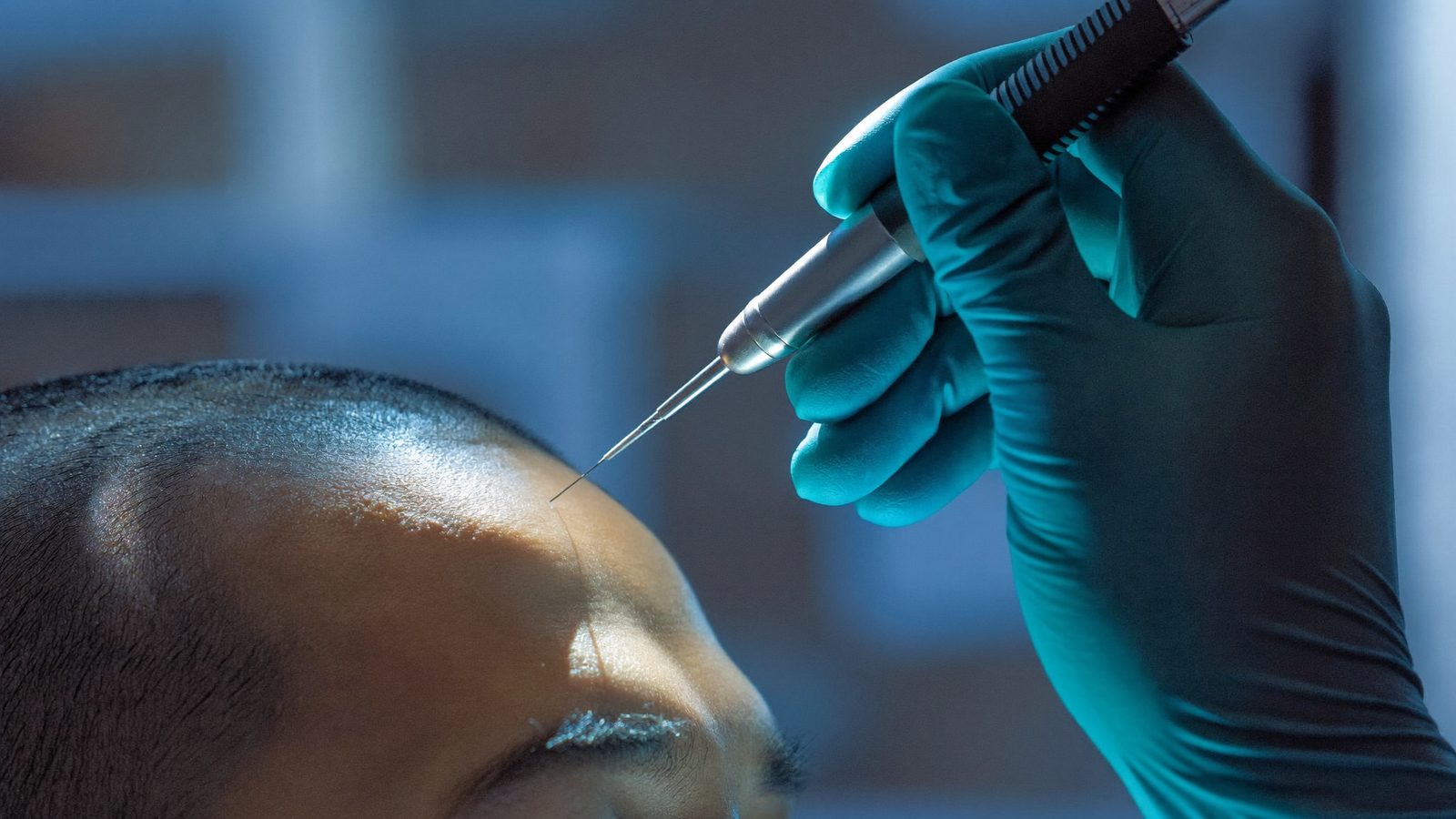 Gloved hand holding a slim implanter pen near a model scalp under surgical light