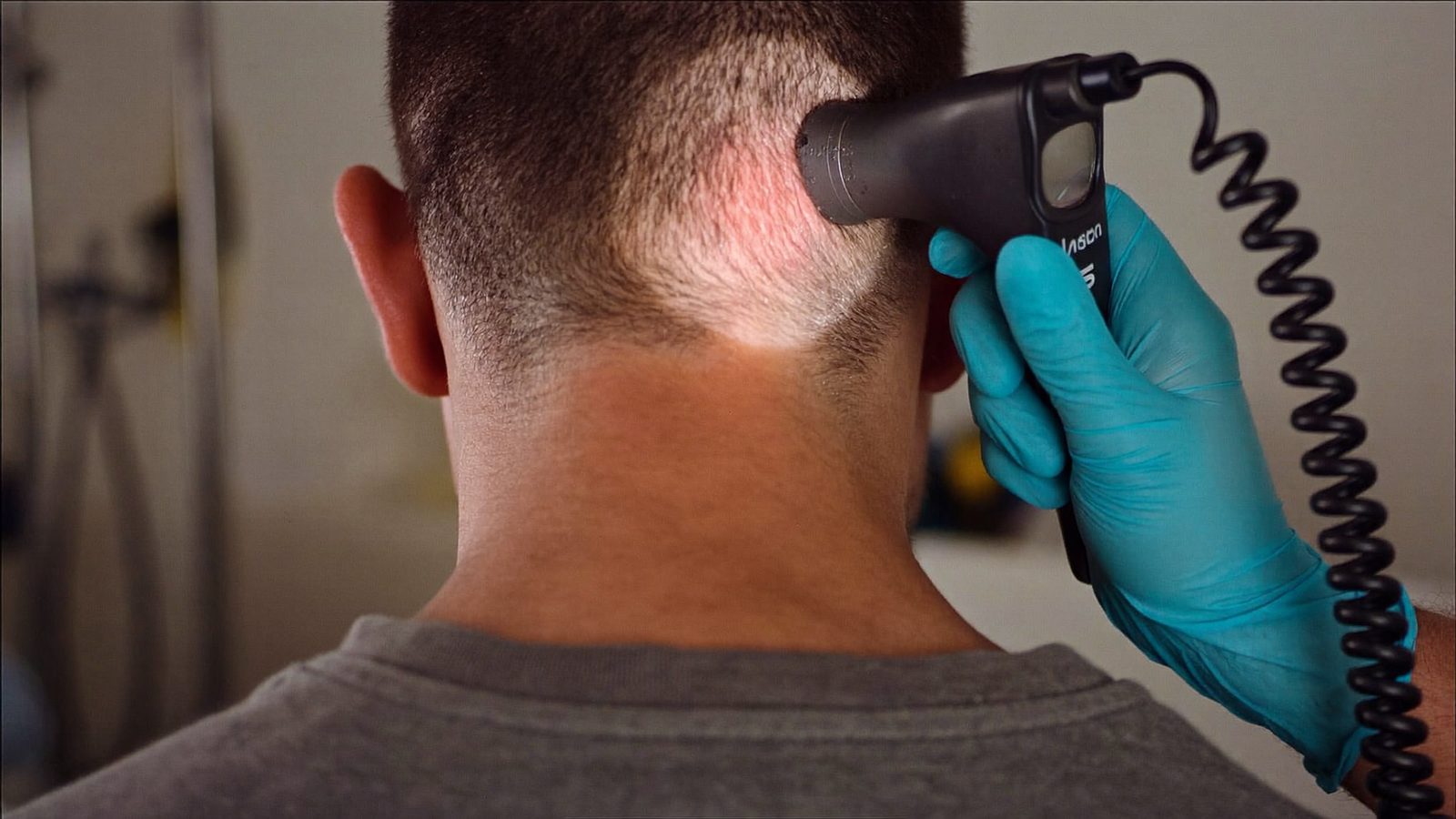 Clinician examining the donor area at the back of a man's head with a magnifying densitometer