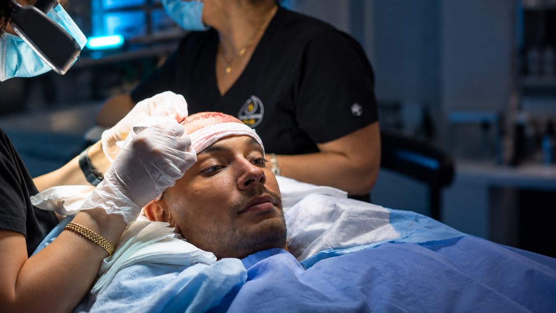 DHI graft placement during a hair transplant at Nova Medical Long Island in Melville