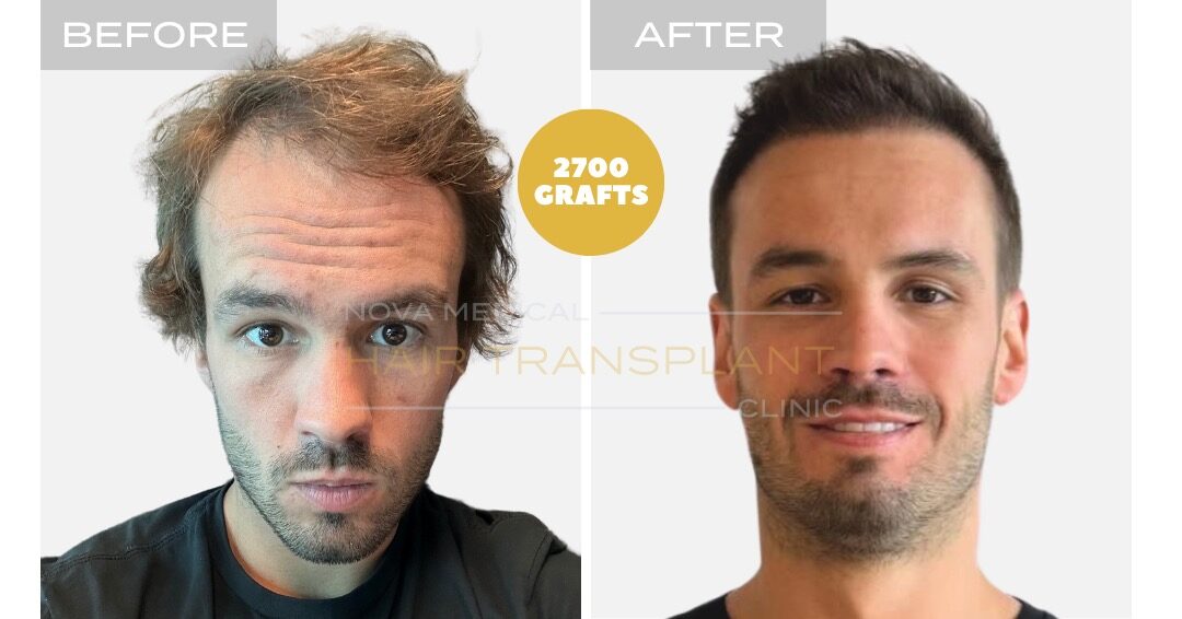 Female Hair Transplant Before and After - Patient 1, Nova Medical