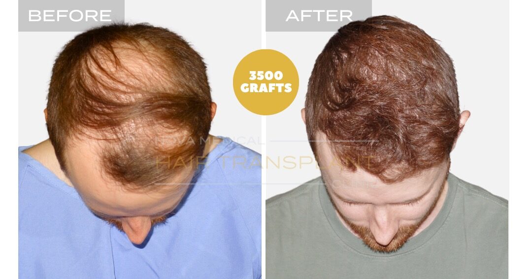 Female Hair Transplant Before and After - Patient 2, Nova Medical