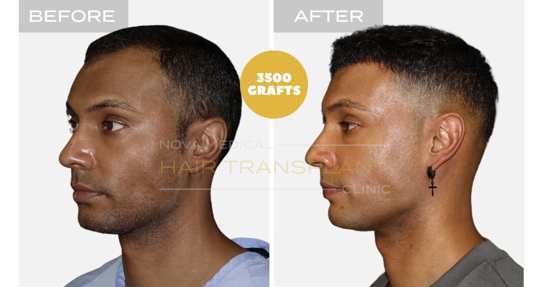 Female Hair Transplant Before and After - Patient 3, Nova Medical