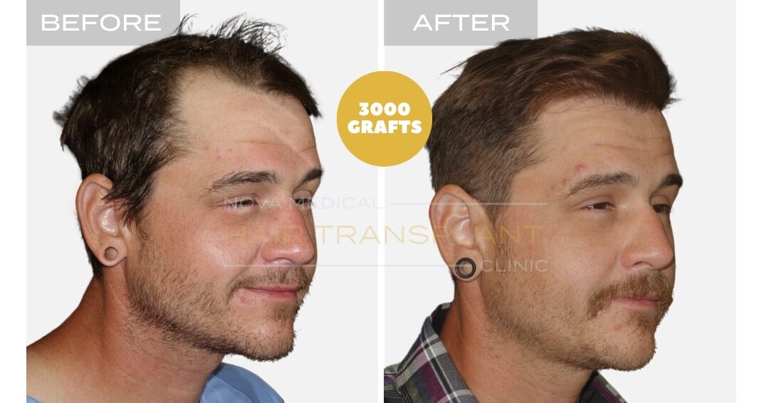Female Hair Transplant Before and After - Patient 4, Nova Medical