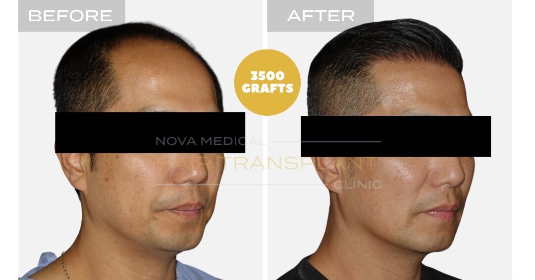 Female Hair Transplant Before and After - Patient 5, Nova Medical