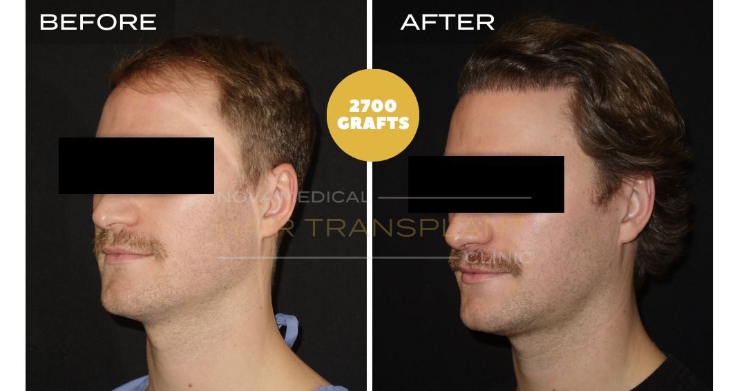 Female Hair Transplant Before and After - Patient 5 angle 2, Nova Medical
