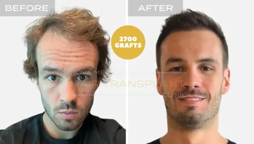 Hair transplant before and after result 1